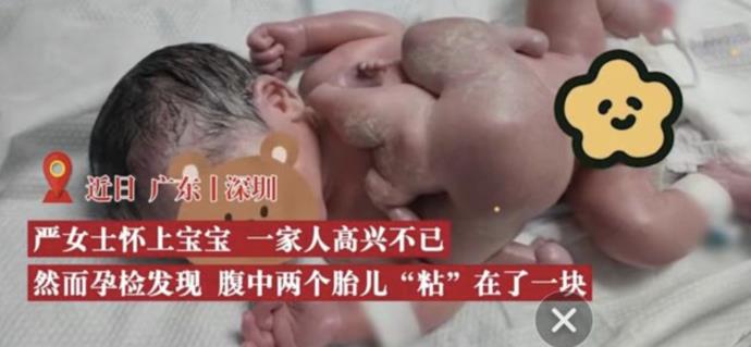 深圳一男婴出生时四手四脚，此案例全球罕见 的第1张图片