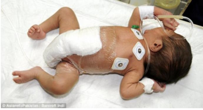 深圳一男婴出生时四手四脚，此案例全球罕见 的第4张图片